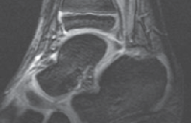 MRI Imagery of Normal Ankle