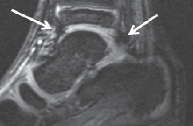 MRI Imagery of Ankle With Early-Stage Joint Disease