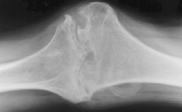 X-Ray Imagery of Late-Stage Joint Disease
