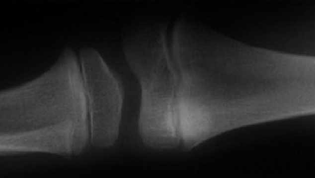 X-Ray Imagery of Normal Knee