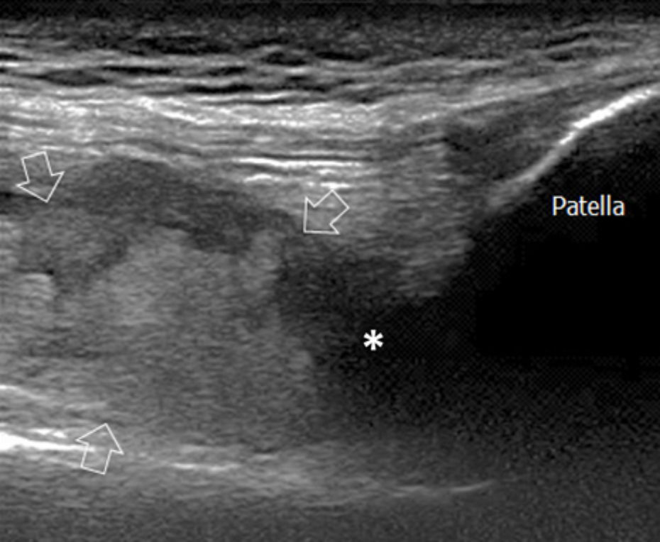 Ultrasound imagery of asymptomatic bleeds in patient with hemophilia