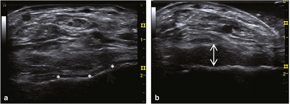 Ultrasound imagery of acute bleeds in patient with severe hemophilia
